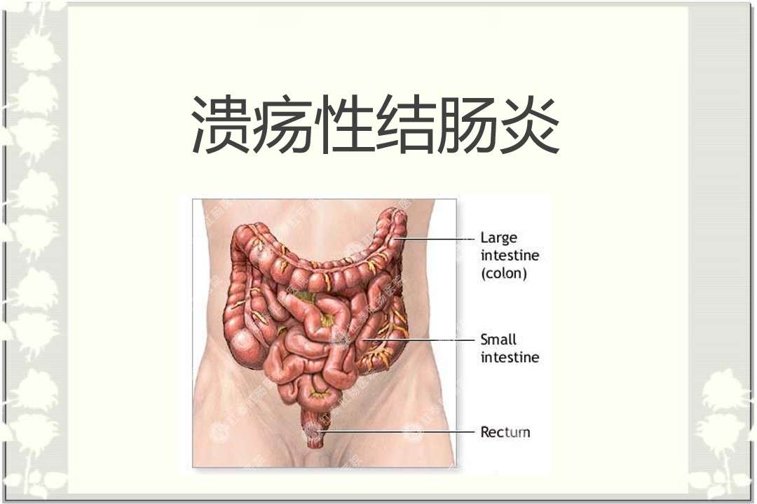 各科室PPT132消化内科-溃疡性结肠炎